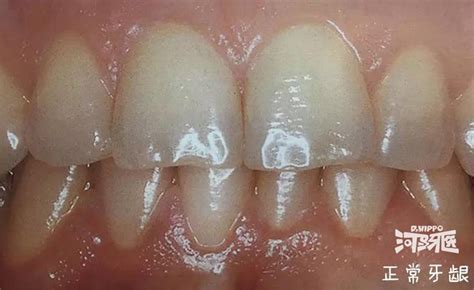 严重的牙周炎会导致牙齿掉光吗