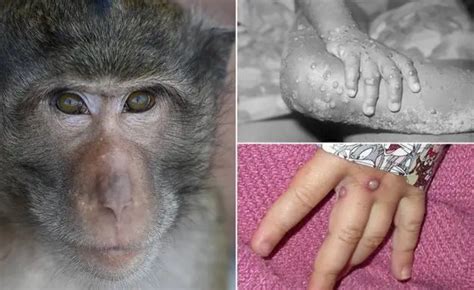 中国会出现猴痘病毒吗