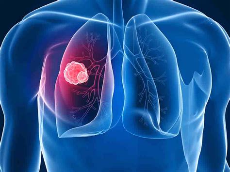 中心型肺癌晚期能好吗