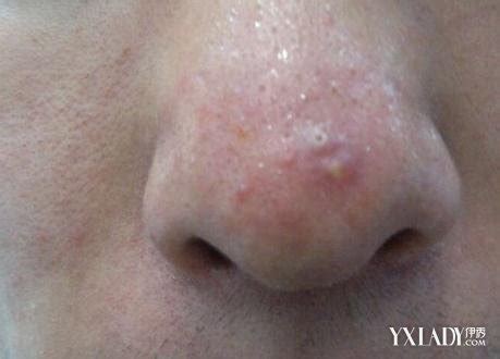 为什么鼻子周围经常长痘痘