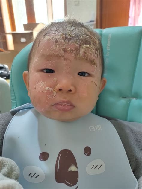 儿童面部烧伤医院照片