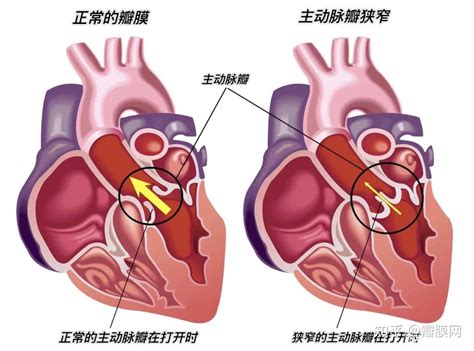 先天性心脏病主动脉少量反流