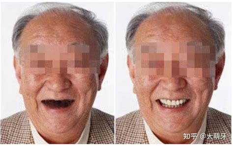 六十岁的老人种牙