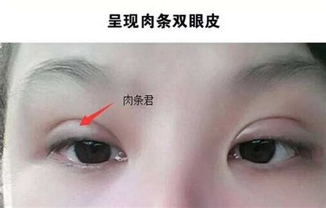 双眼皮术后怎么快速消除淤青
