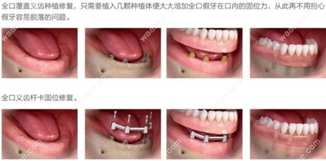 可摘义齿和固定牙的区别