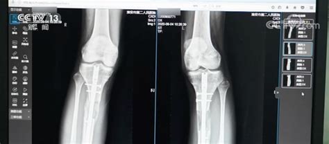 大腿骨摔断做手术多长时间