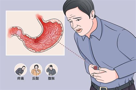 如何判断胃炎和胃溃疡