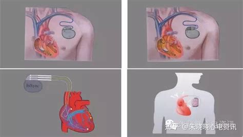 心脏体外起搏器是什么
