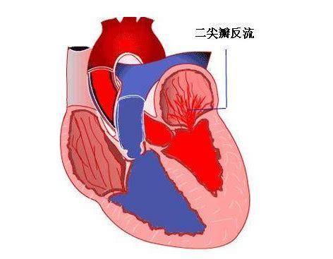 心脏反流是治不好的吗