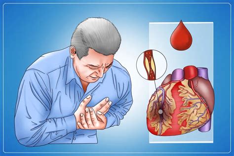 心脏梗塞的前兆怎么治疗