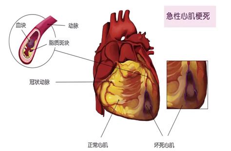 心脏腔梗是怎么回事如何治疗
