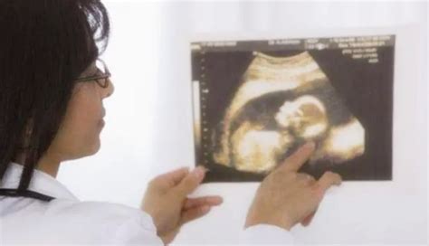 怀孕几个月时胎儿容易畸形