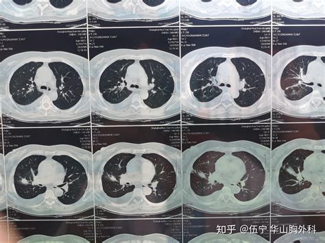 回国CT肺部证明怎么写图片