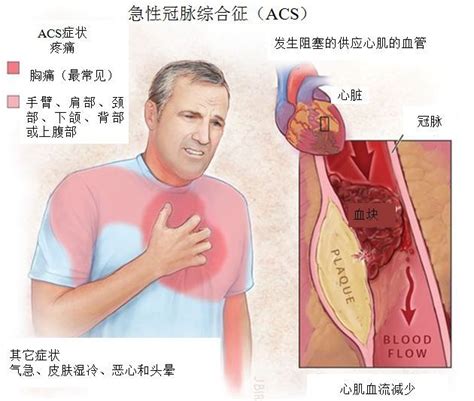急性冠状动脉综合征的急救原则