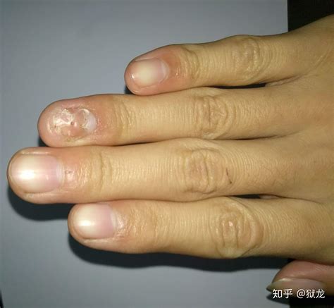 手指受伤后指甲不长了
