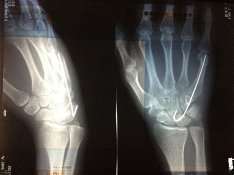 手腕骨折一个月能恢复到什么程度