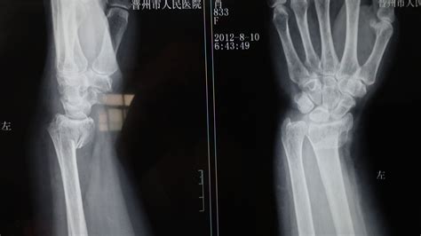 手腕骨折四个月恢复到什么程度