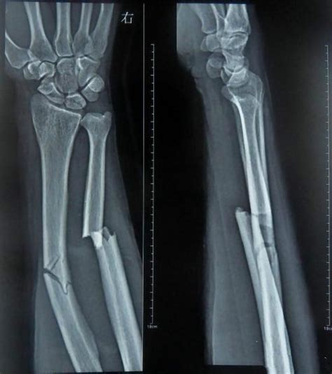 手腕骨折100天能恢复到什么程度