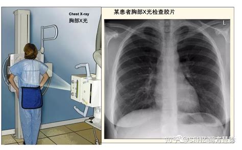 拍肺片能检查出什么