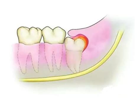 智齿冠周炎可以用力刷牙