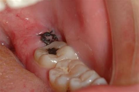 智齿有牙洞会引起口臭吗