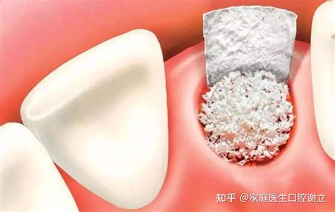 植牙用骨粉有几种