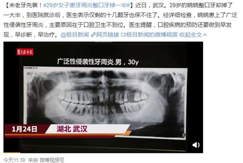 武汉26岁女子整口牙掉了一大半