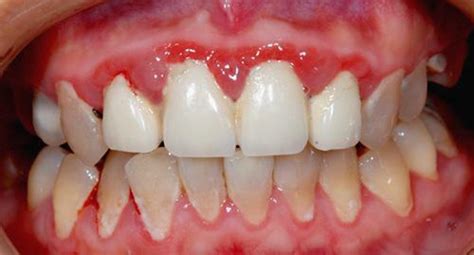 牙周炎与牙龈炎的照片