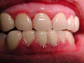 牙龈容易出血是不是牙周不好