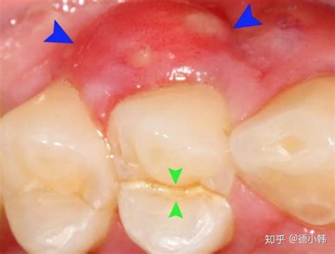 牙龈流白脓长达一个月