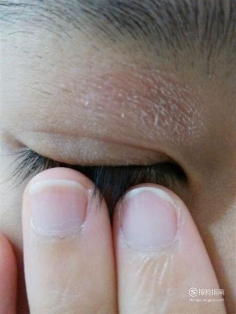 眼周皮肤频繁过敏是什么原因