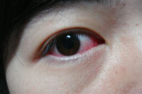 眼睛红肿疼可以挂急诊