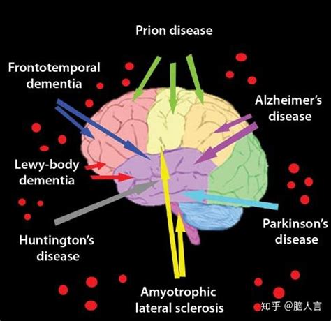 神经退行性疾病伴脑铁沉积症症状
