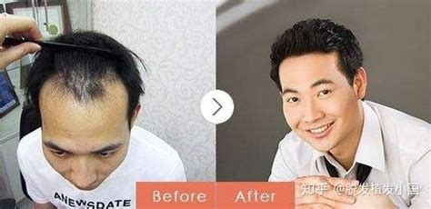种头发的手术过程