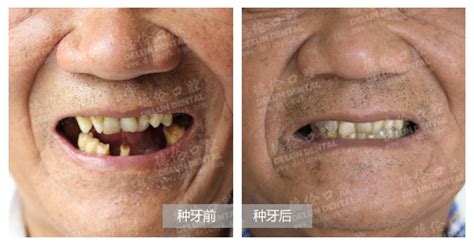 老人种牙要多少钱