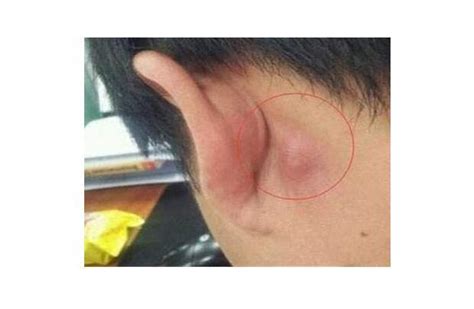 耳朵后面长痘什么原因引起