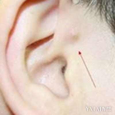 耳朵后面长痘是什么原因