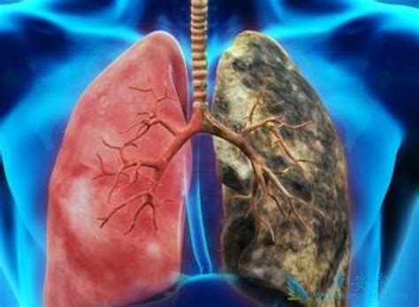 肺癌中哪种癌症发病后发展比较慢