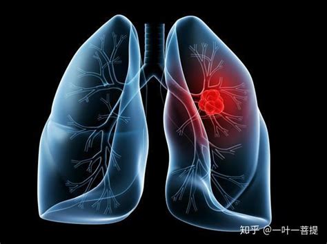 肺癌四期是晚期吗