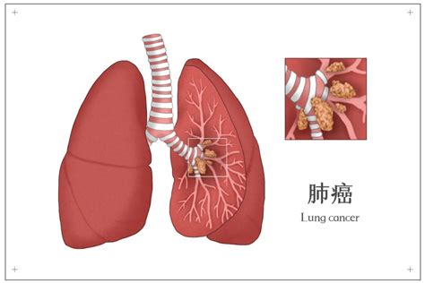 肺癌早期有什么症状出现
