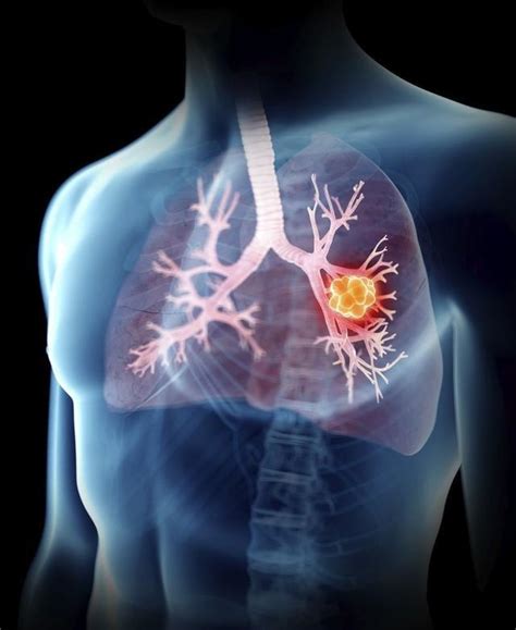 肺癌是不是最可怕的癌症