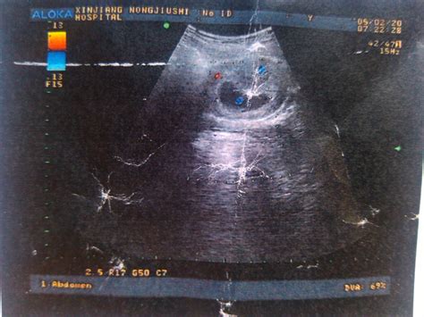 胎儿胆道闭锁的彩超表现