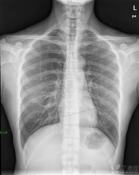 胸片和肺片有什么区别