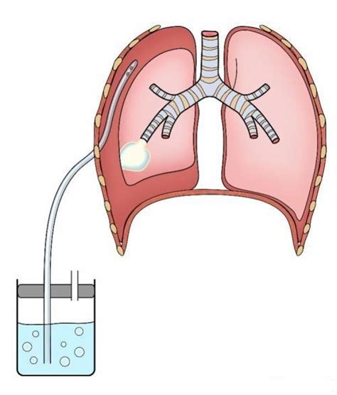 胸腔闭式引流管图示