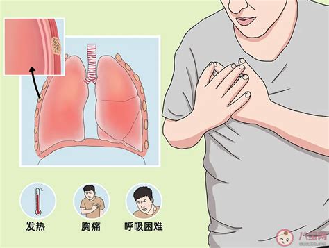 胸膜炎的治疗办法