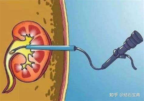 输尿管结石治疗方法