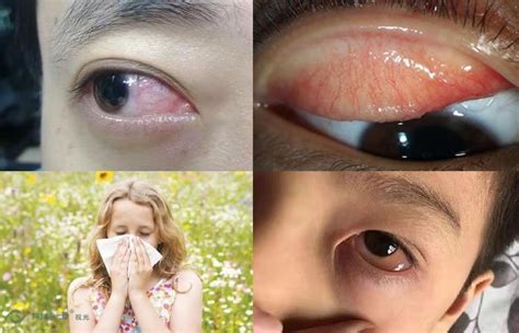 过敏导致眼睛肿怎么办