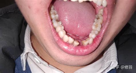 重度牙周炎最终牙齿都会掉光吗