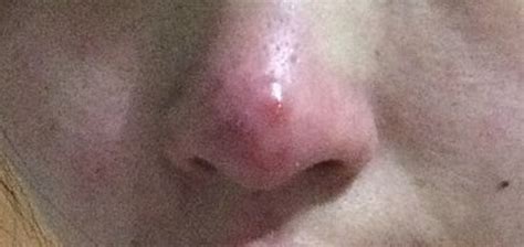 鼻子周围长很多小痘痘是什么原因
