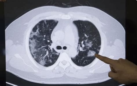 29岁姑娘无症状确诊肺癌了